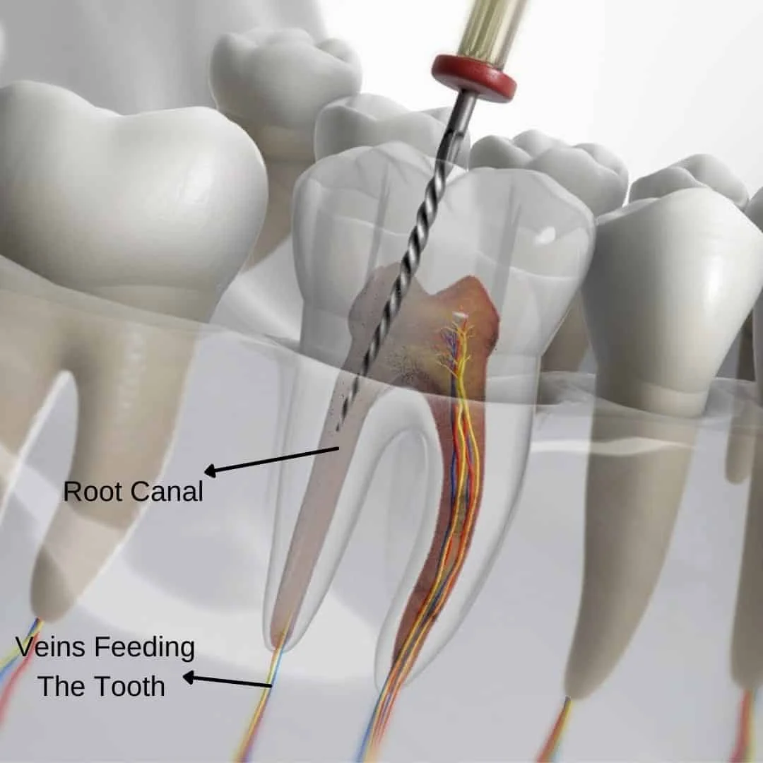 Endodontics (Root Canal Treatment)