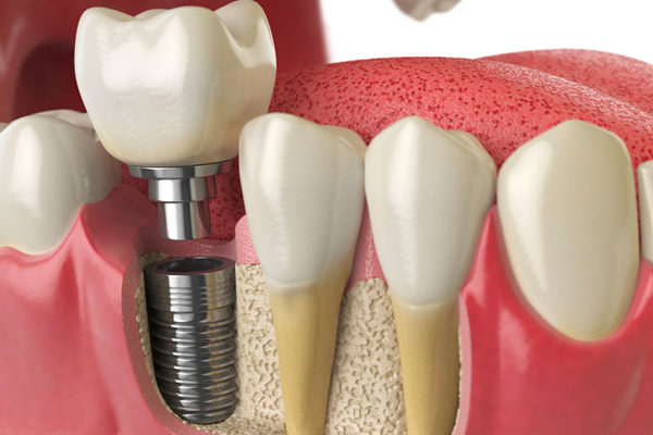 Dental Implants