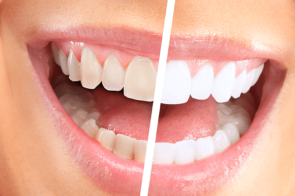 Teeth Bleaching (Whitening)